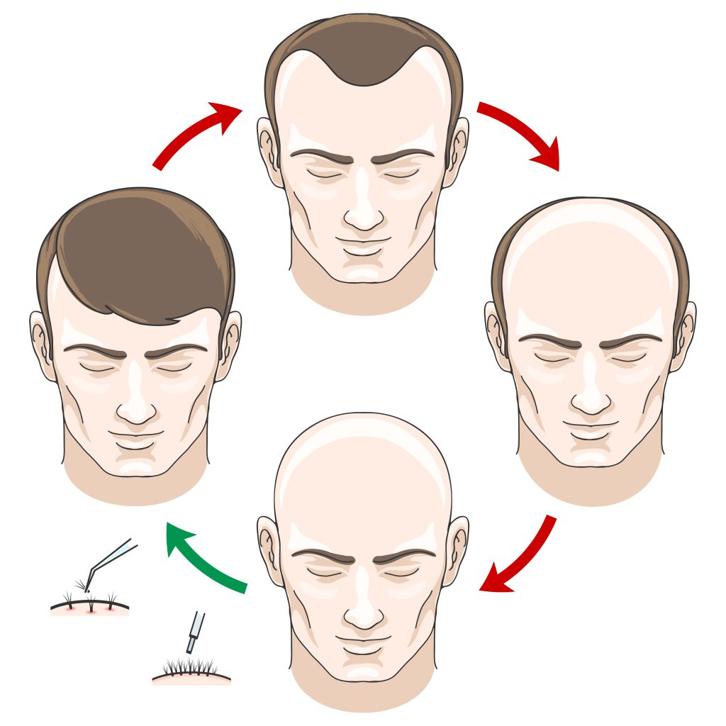 male bald pattern
