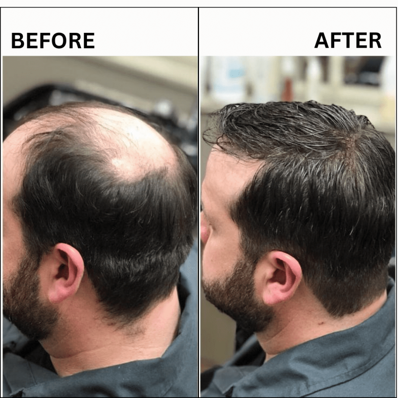 Alak before after results