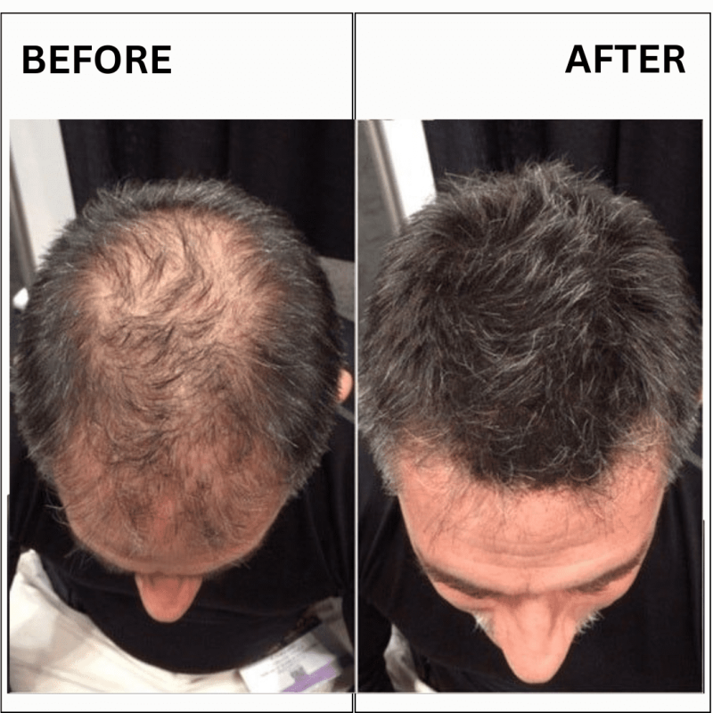 alak before and after results